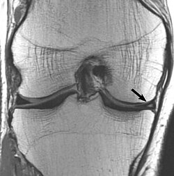 MRI — Medial Meniscus