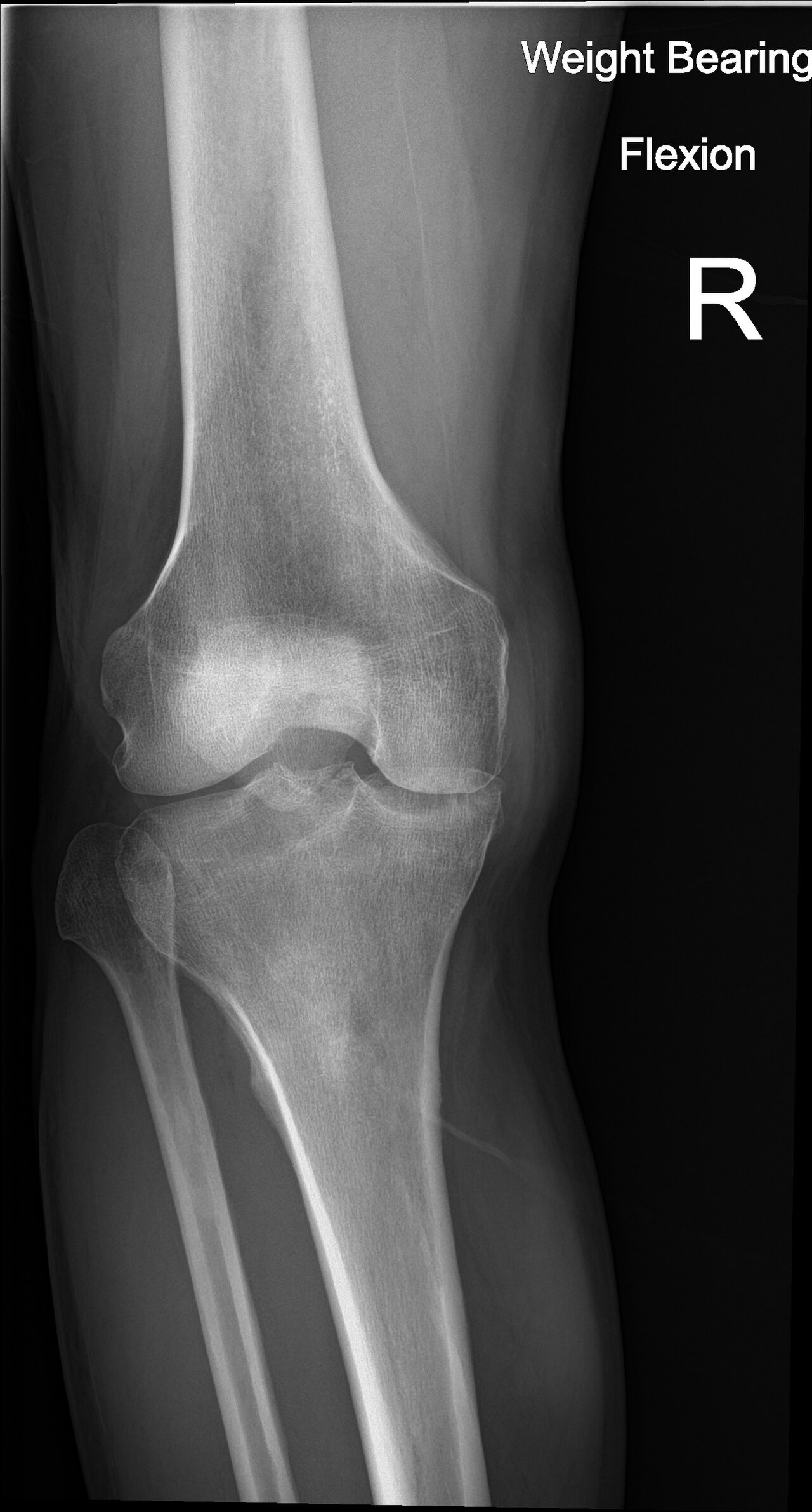 Knee X-ray — Osteoarthritis