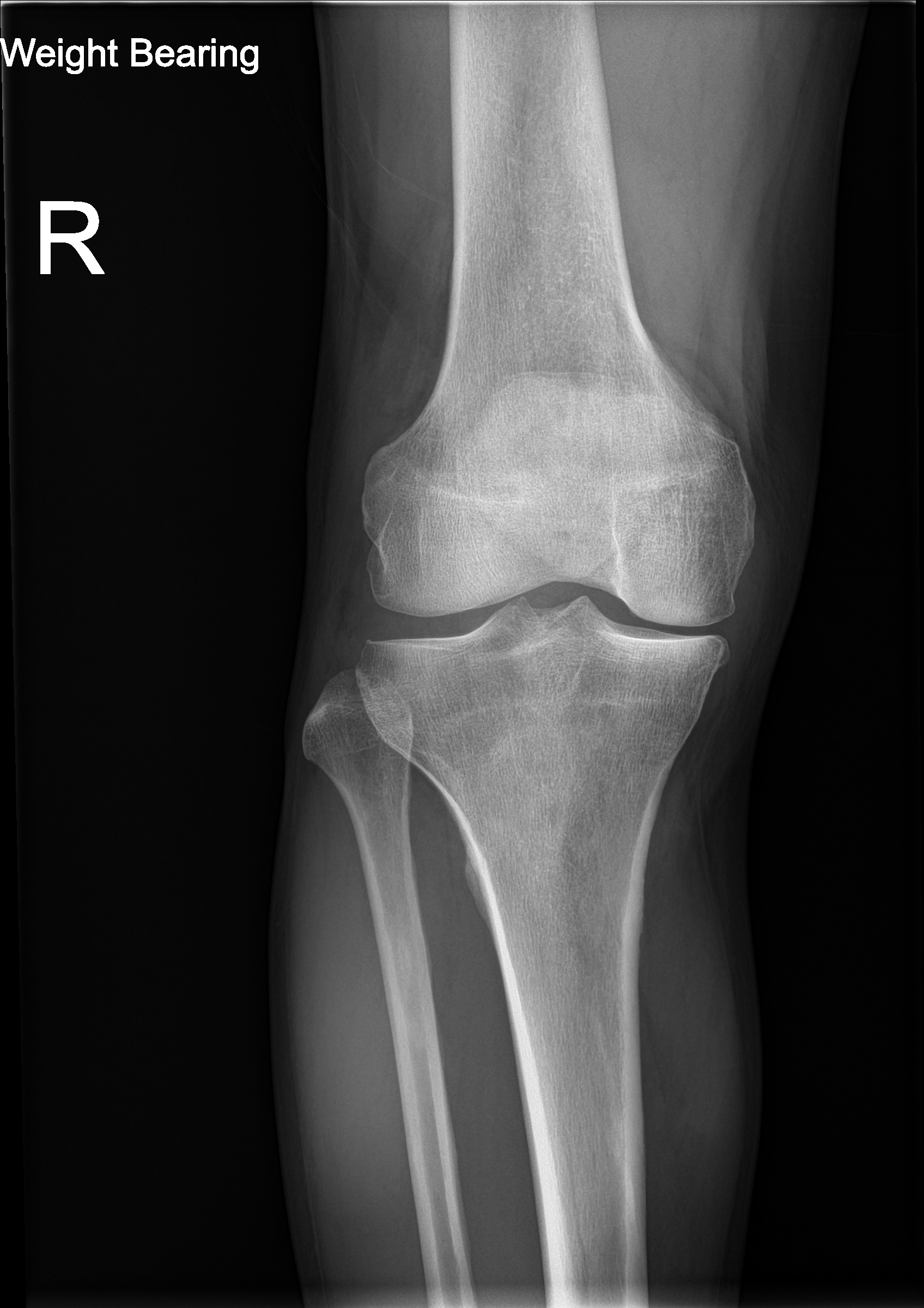 Knee X-ray — Osteoarthritis