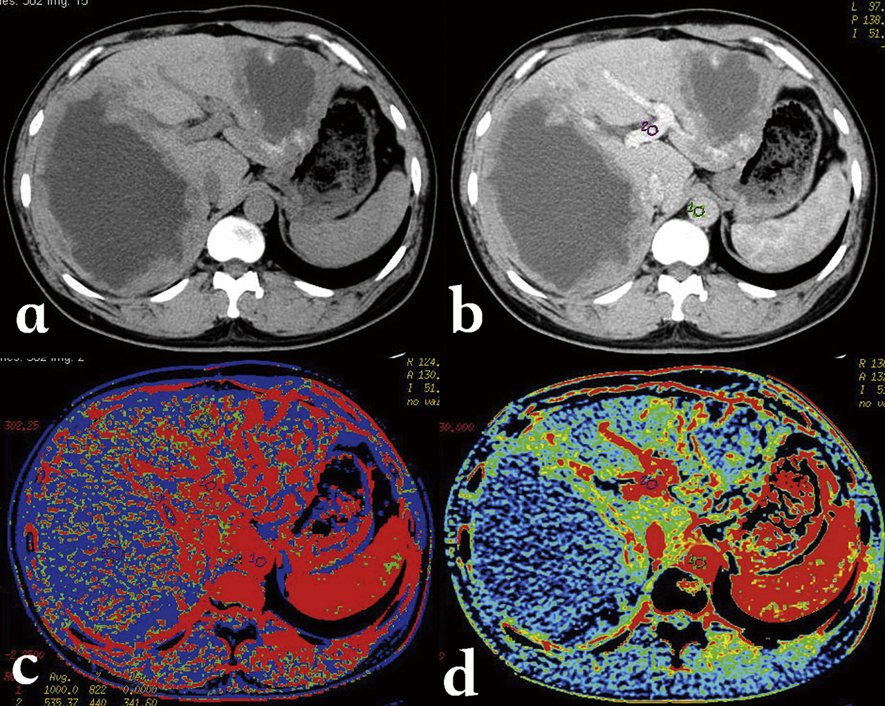 Liver CT — Contrast Enhanced