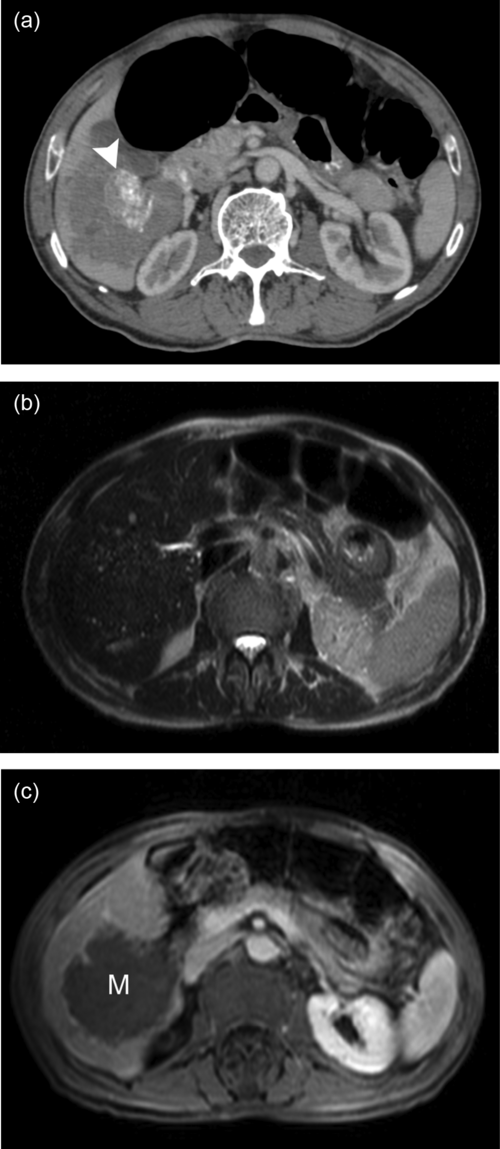 Liver MRI — Focal Lesion