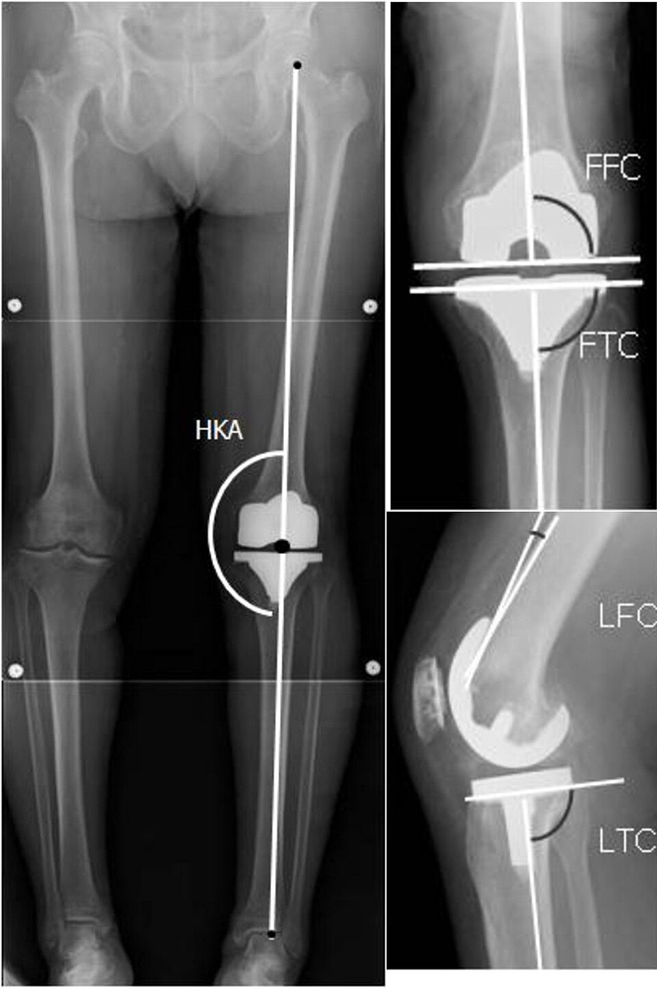 Knee X-ray — Lateral