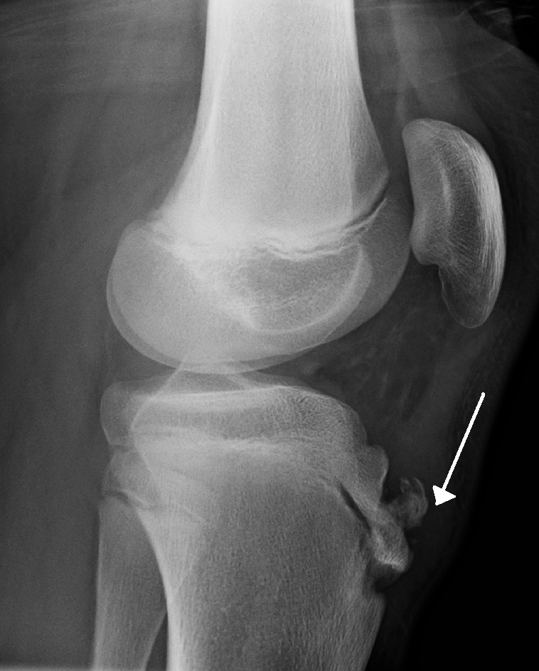 Knee X-ray — Lateral