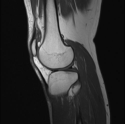 Knee MRI — Sagittal