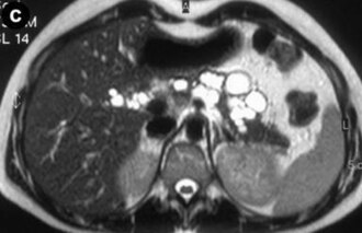 Pelvis MRI — Axial