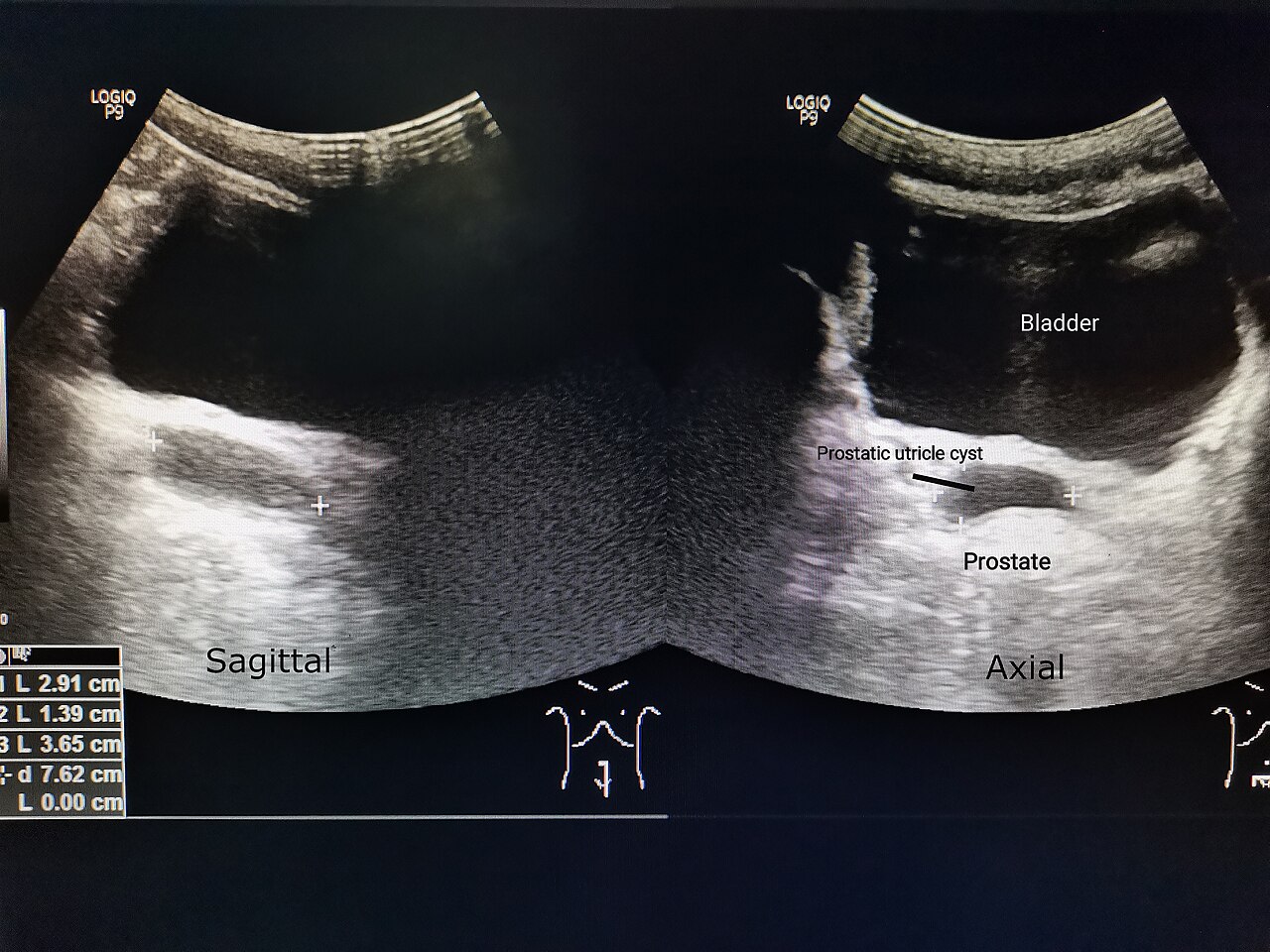 Prostate Ultrasound