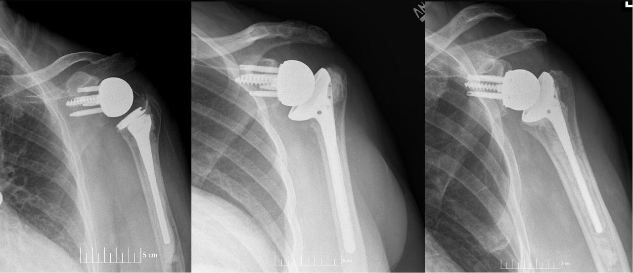 Shoulder X-ray — AP