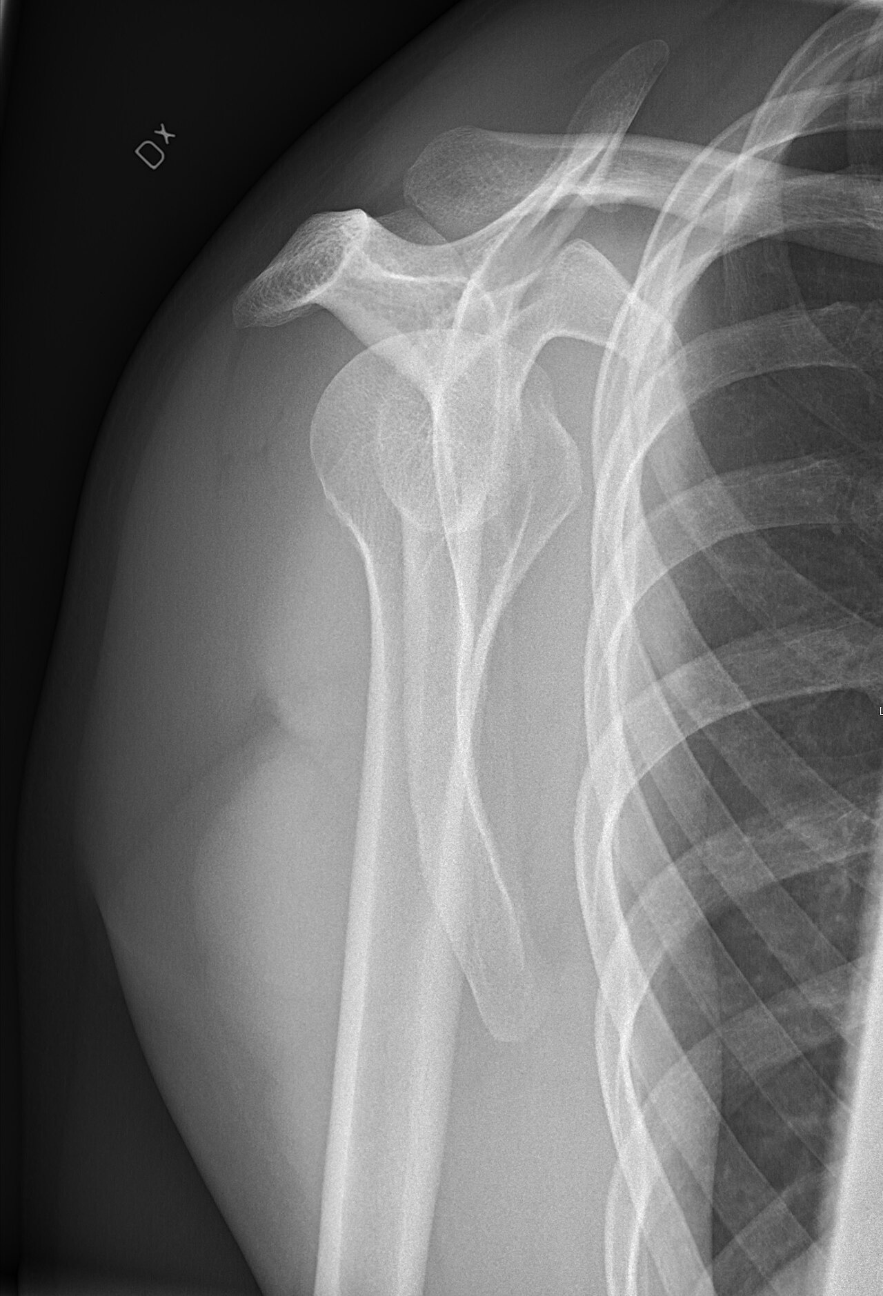 Shoulder X-ray — AP