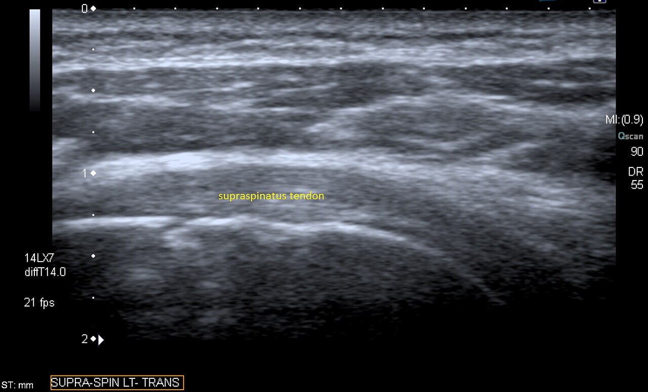 Shoulder Ultrasound — Tendon