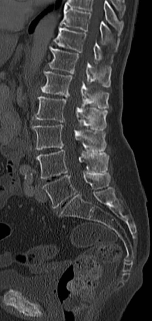 Lumbar CT — Sagittal