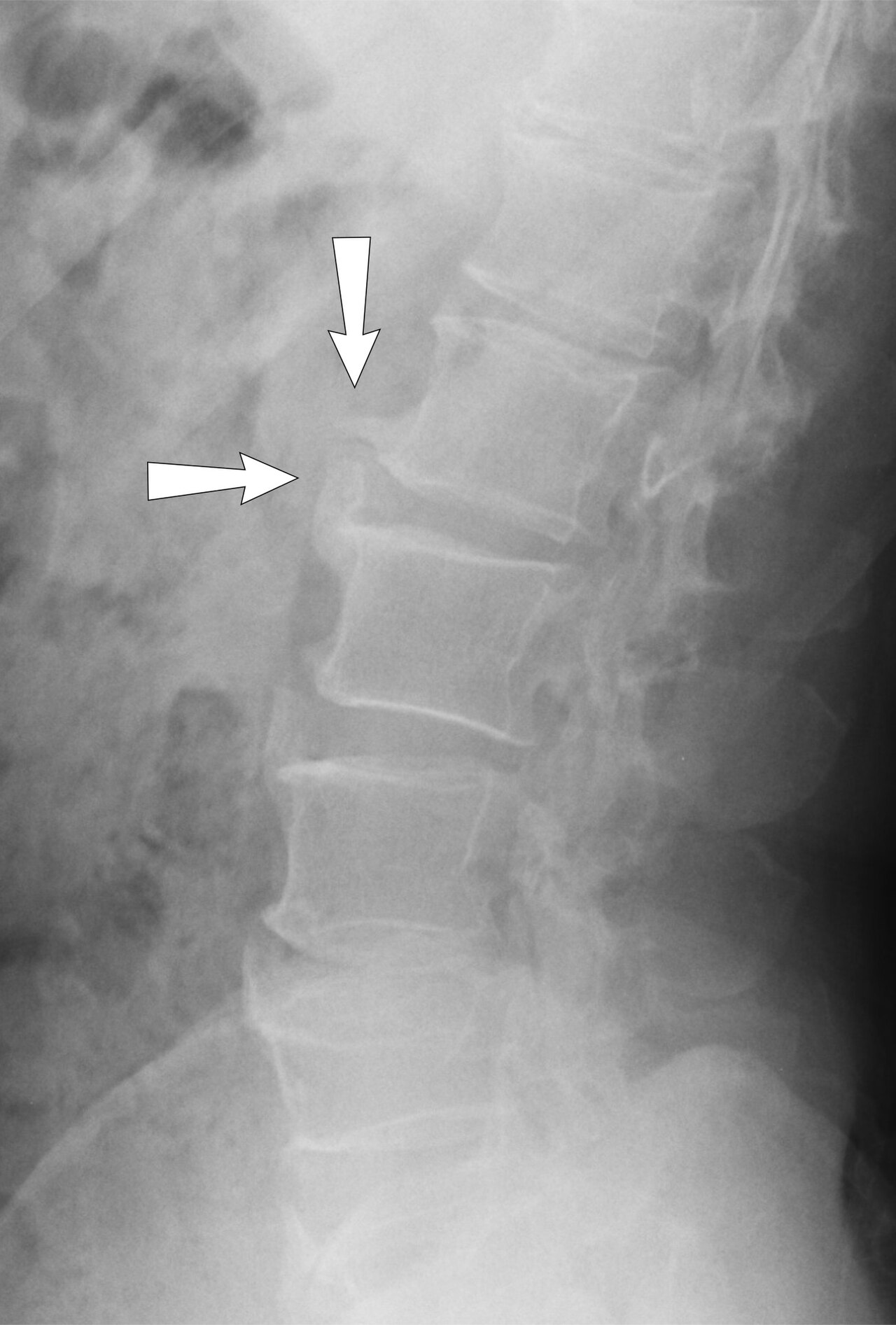 Lumbar X-ray — Lateral