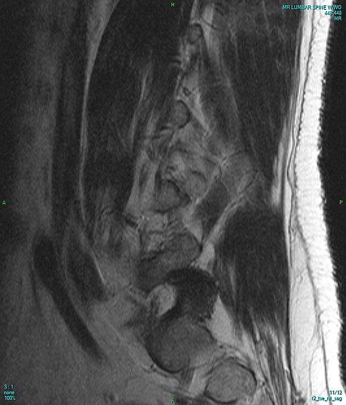 Lumbar MRI — Sagittal