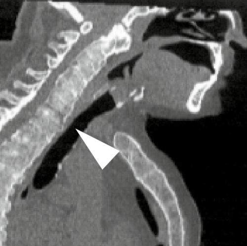 CT — Spine Fracture