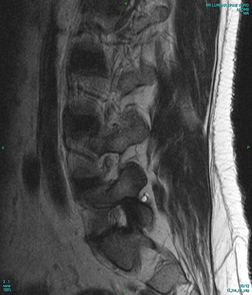 MRI — Vertebral Fracture