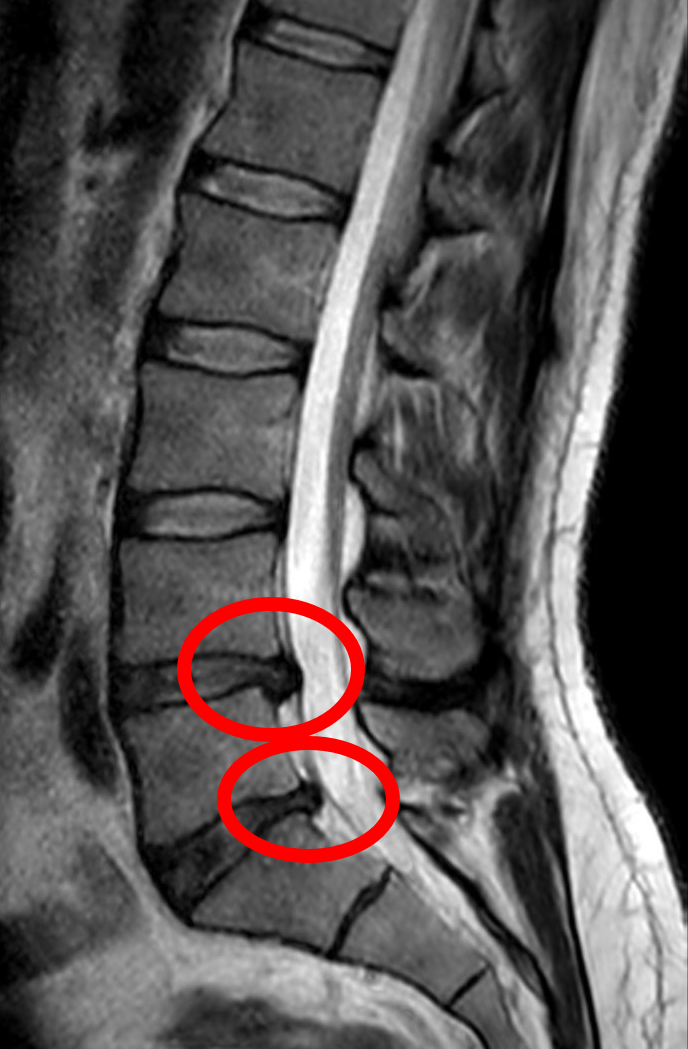 MRI — Herniated Disc