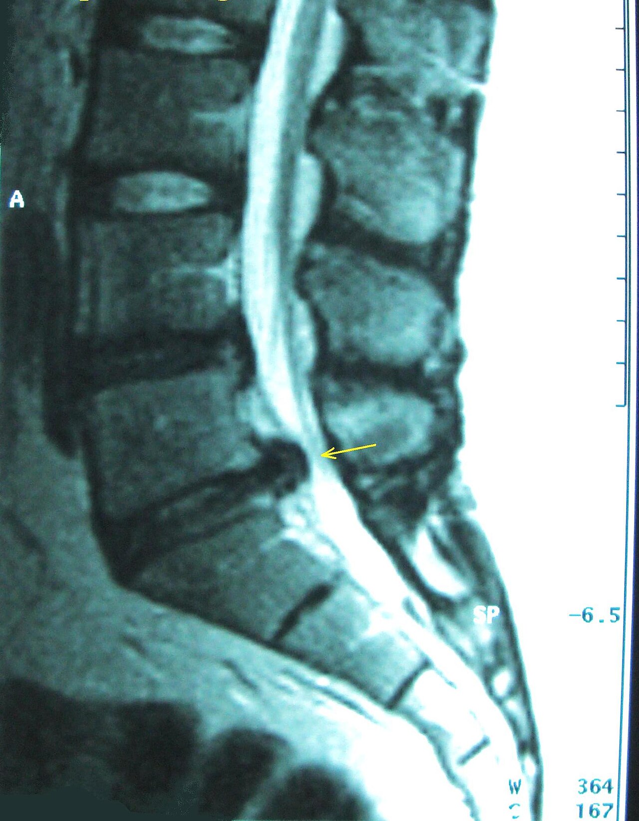 MRI — Disc Herniation