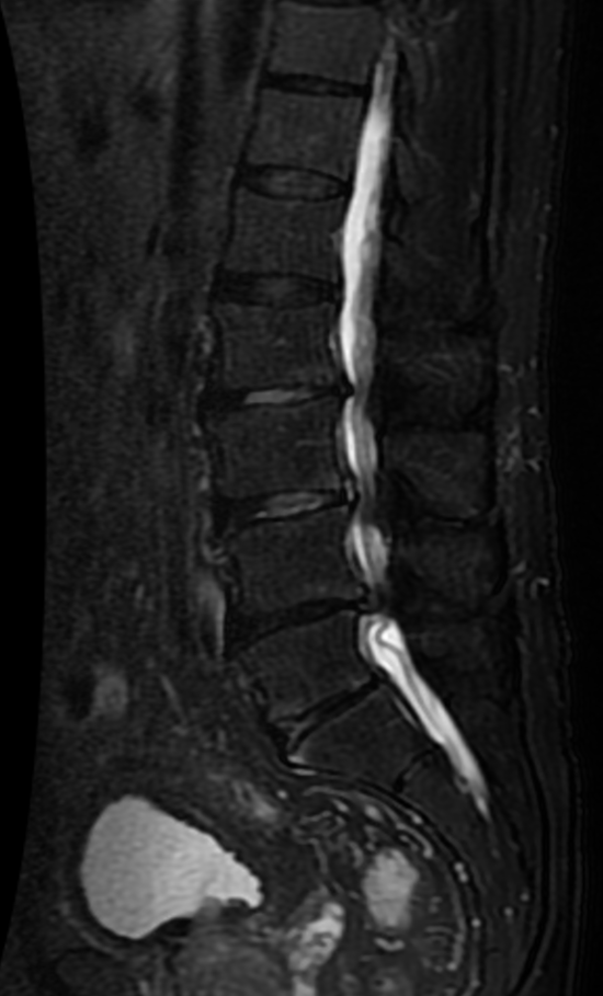 MRI — Spinal Stenosis