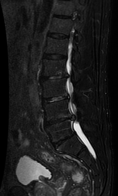 MRI — Spinal Stenosis