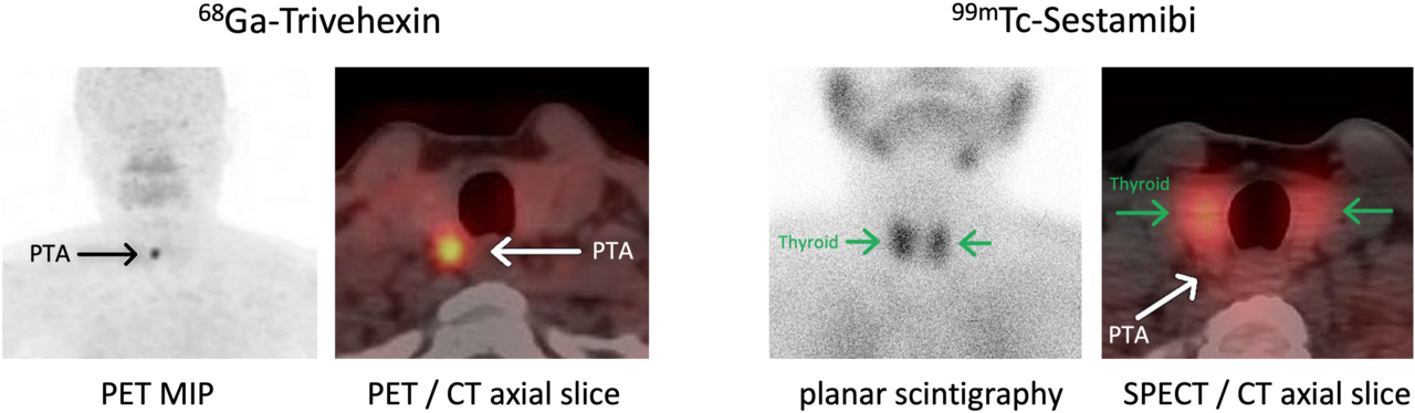 Thyroid Nuclear Scan
