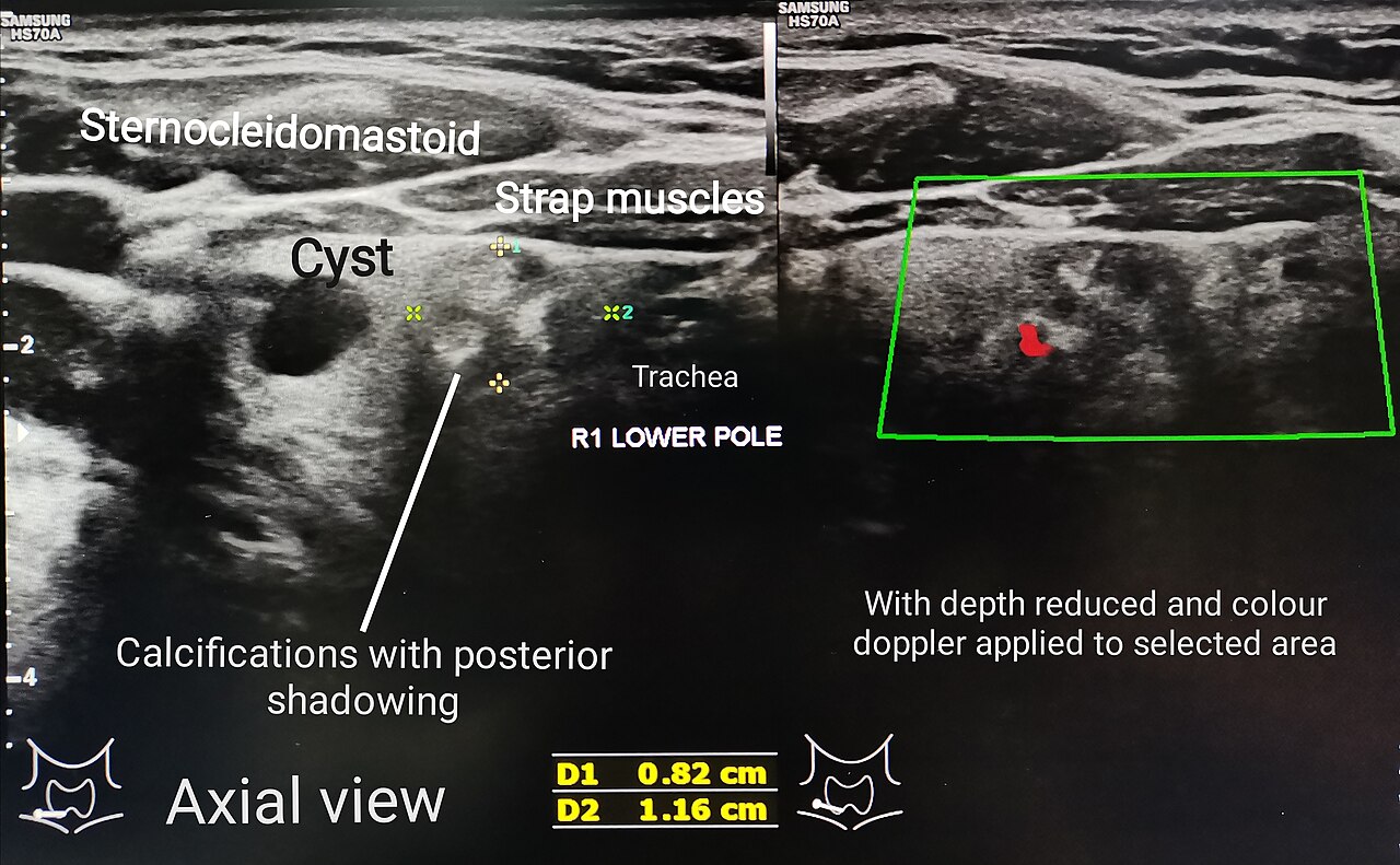 Thyroid Ultrasound — Nodule