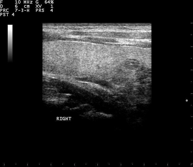Thyroid Ultrasound — Overview