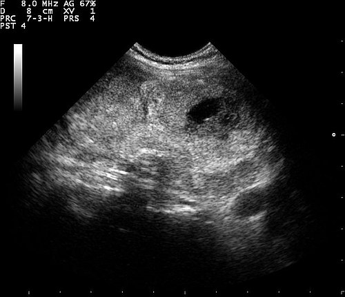 Thyroid Ultrasound — Overview