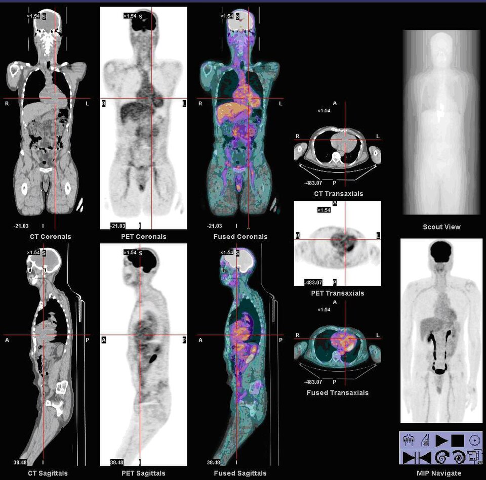 Whole Body PET/CT — FDG
