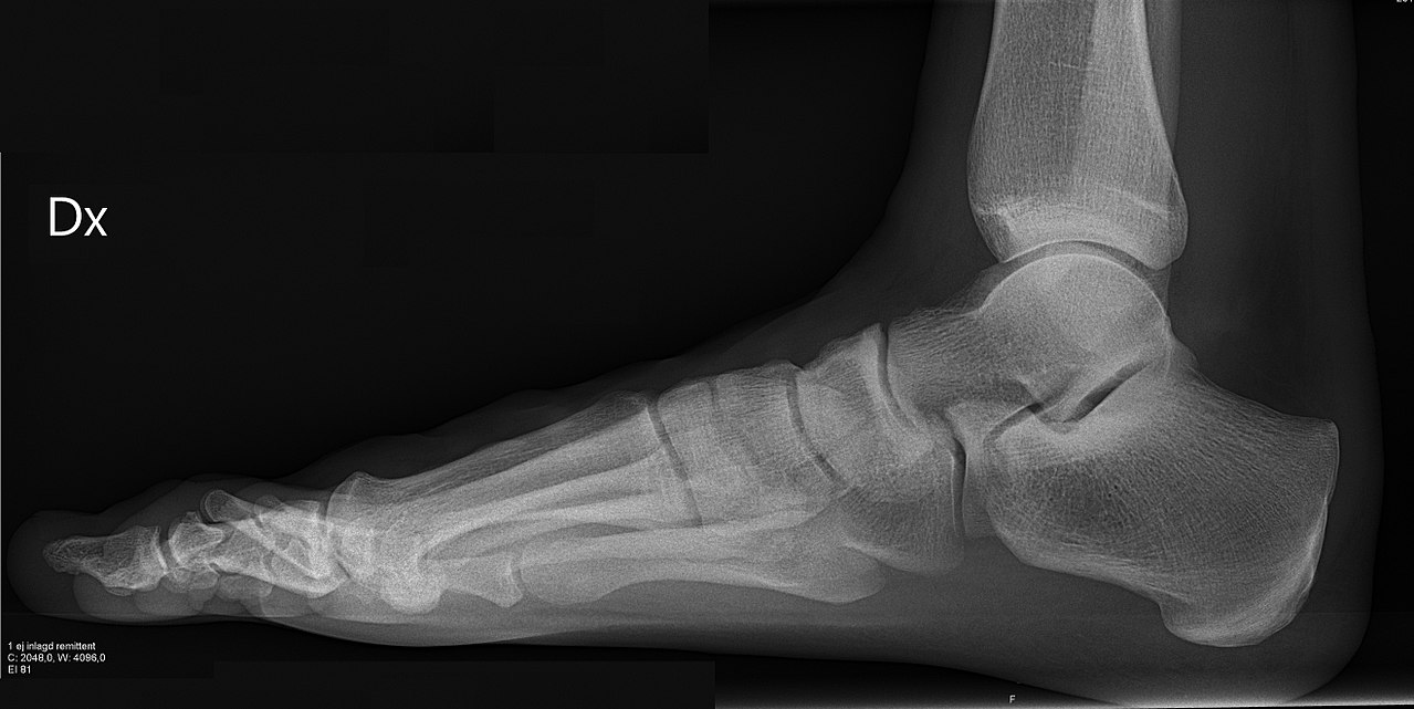 Wrist X-ray — Lateral