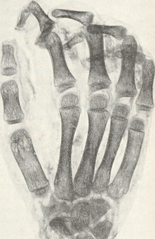 Hand X-ray — PA View