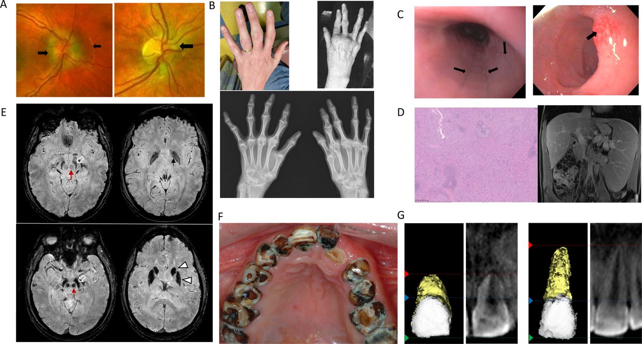 Wrist MRI — Coronal