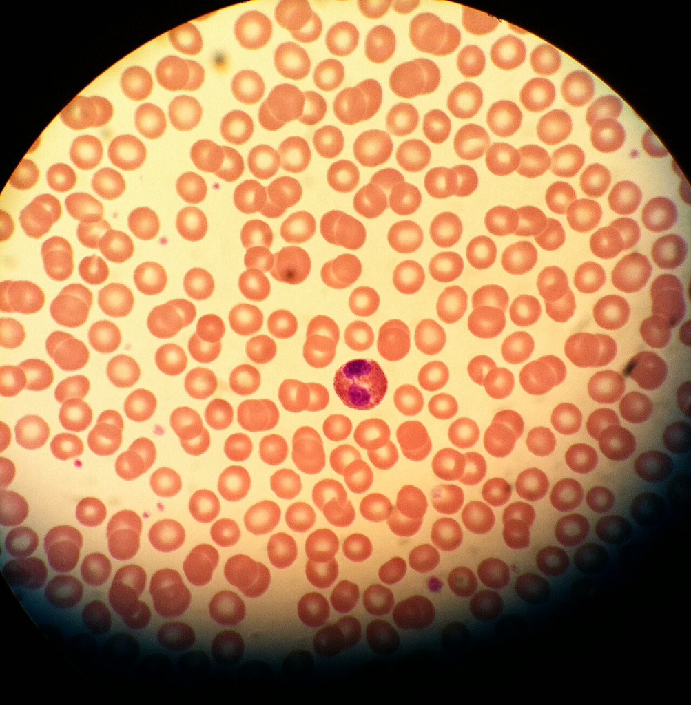 Eosinophil with RBCs and Platelets