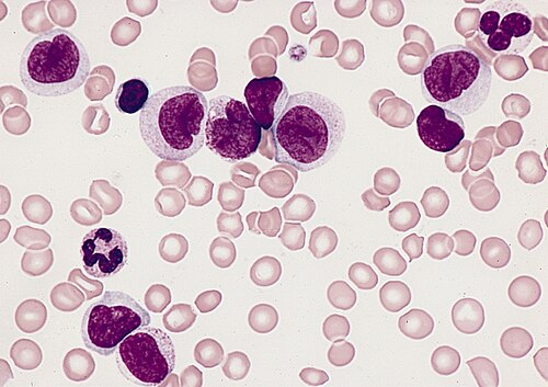 Bone Marrow — Acute Myelomonocytic Leukemia