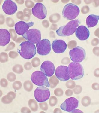 Bone Marrow — Acute Lymphoblastic Leukemia