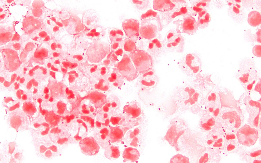 Neisseria meningitidis — Gram Stain (CSF)