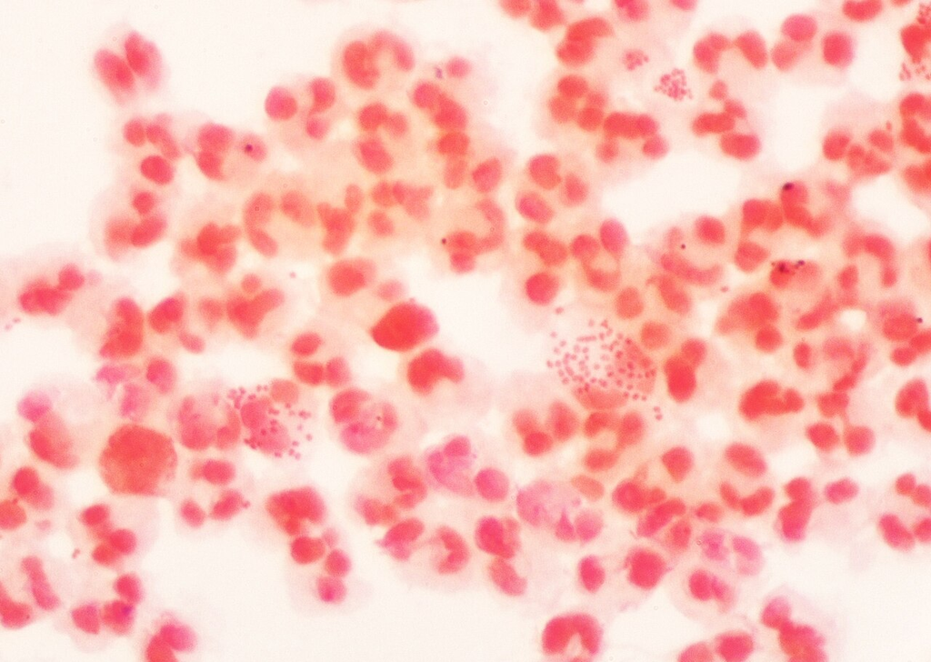 Gram-Negative Diplococci with Pus Cells