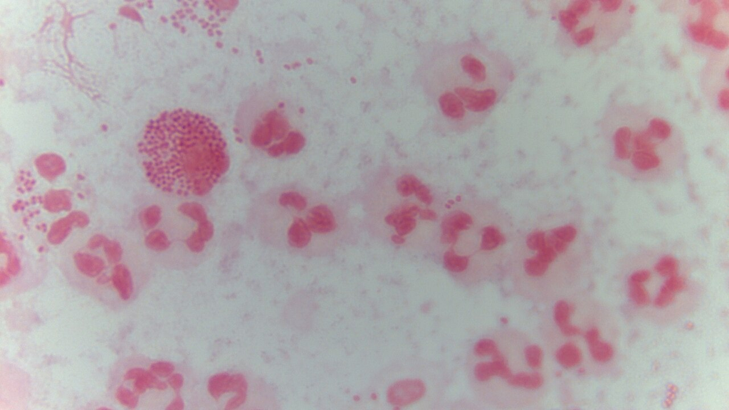 Neisseria gonorrhoeae — Gram Stain (Urethral)