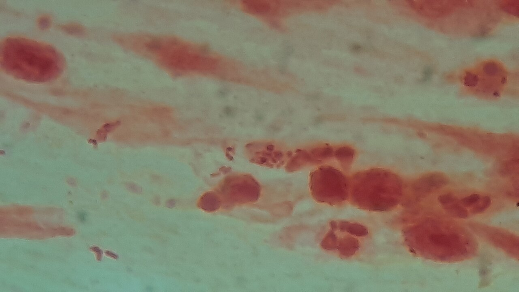 Sputum Gram Stain — Gram-Negative Bacteria with Pus Cells