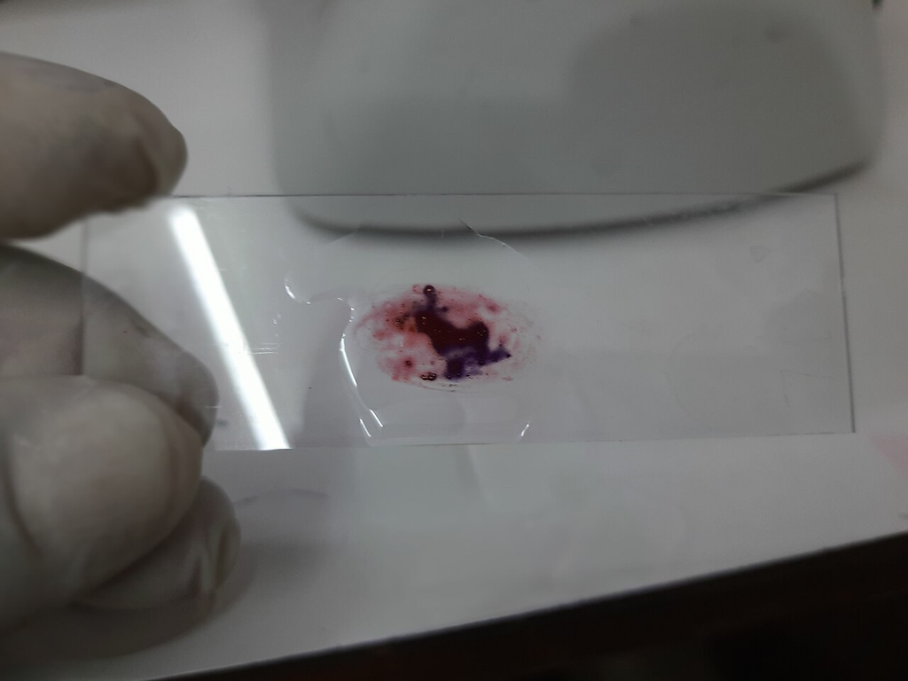 Sputum Gram Stain — Mixed Flora