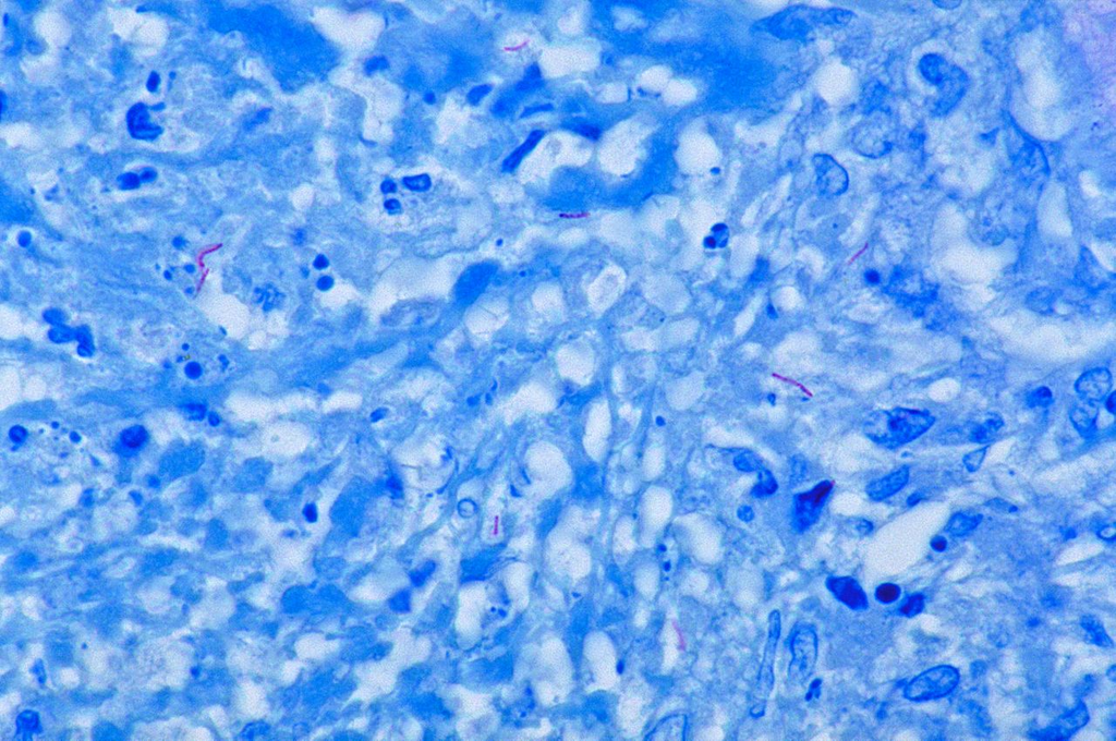Mycobacterium tuberculosis — Acid-Fast Stain