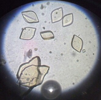 Uric Acid Crystals — Urine Sediment