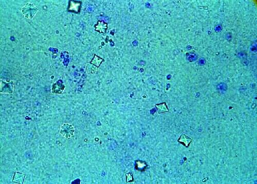 Calcium Oxalate Crystals — Urine Sediment