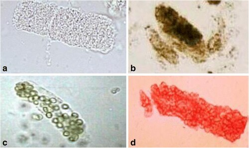 Urinary Casts — Mixed Types
